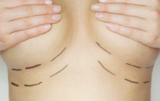 frauen oberkoerper mit bruesten und schnittzeichnungen bei der vorbereitung zur brustvergroesserung