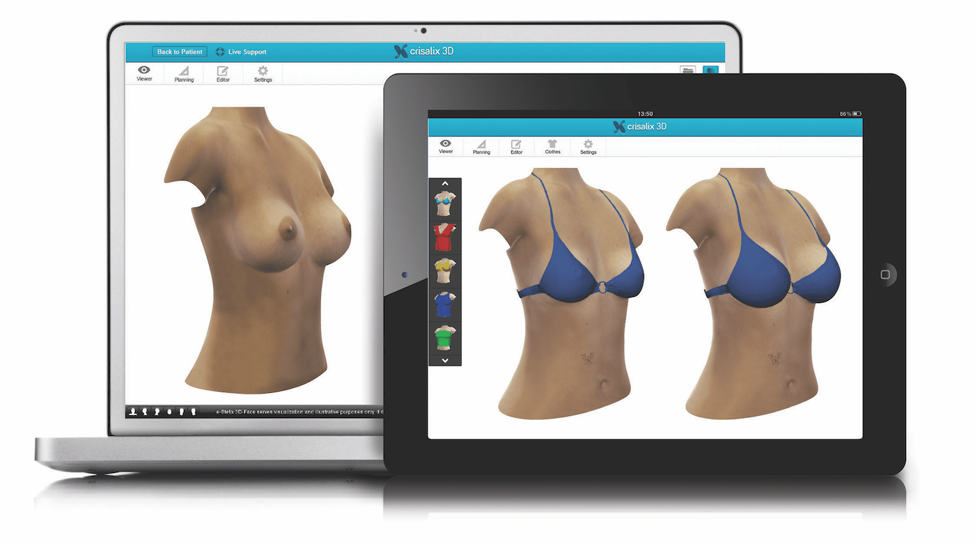 crisalix-3d-simulation-busen darstellung 3 d simulation auf tablet und laptop