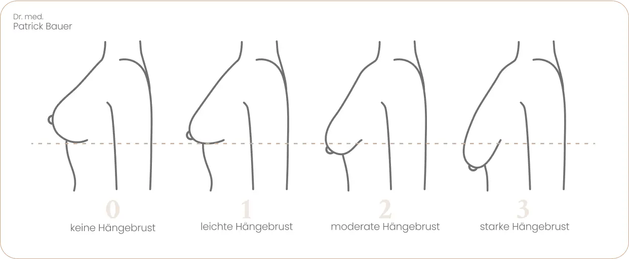 haengebrust schwergrade dr bauer haengebrust schwergrade dr bauer