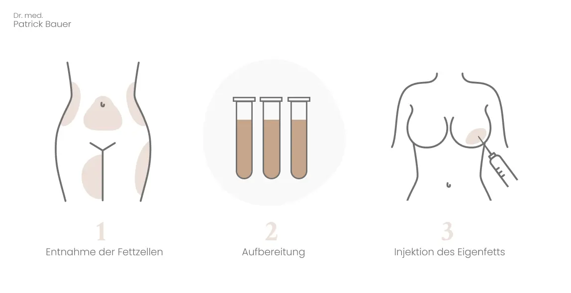 dr bauer brustvergroesserung eigenfett ablauf