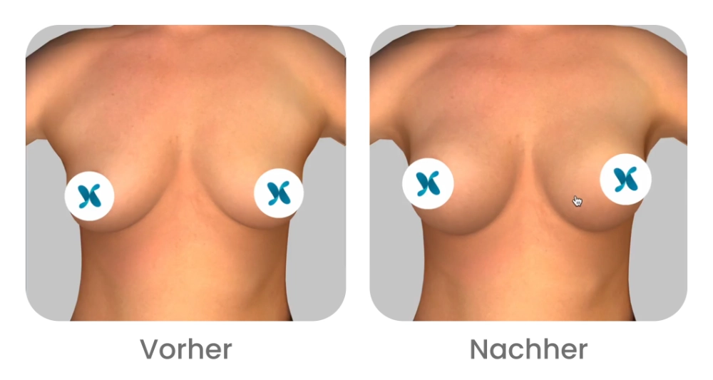 vorher nachher brustvergroesserung 3d simulation crisalix